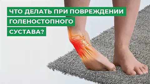 Что делать при повреждении голеностопного сустава? Рекомендации опытного врача-ортопеда