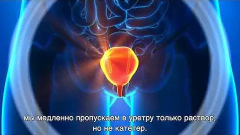 Инстилляции мочевого пузыря без катетера и без боли - UroDapter + УРОЛАЙФ